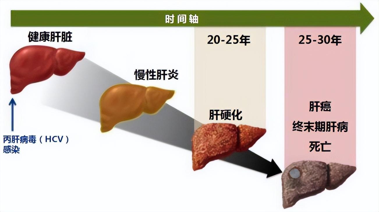 肝病最新进展概览，最新研究与治疗突破